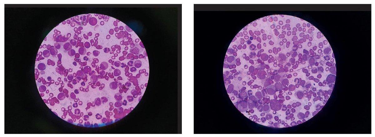 Evaluation of Yumizen H2500/1500 and Sysmex XN1000 leukocyte