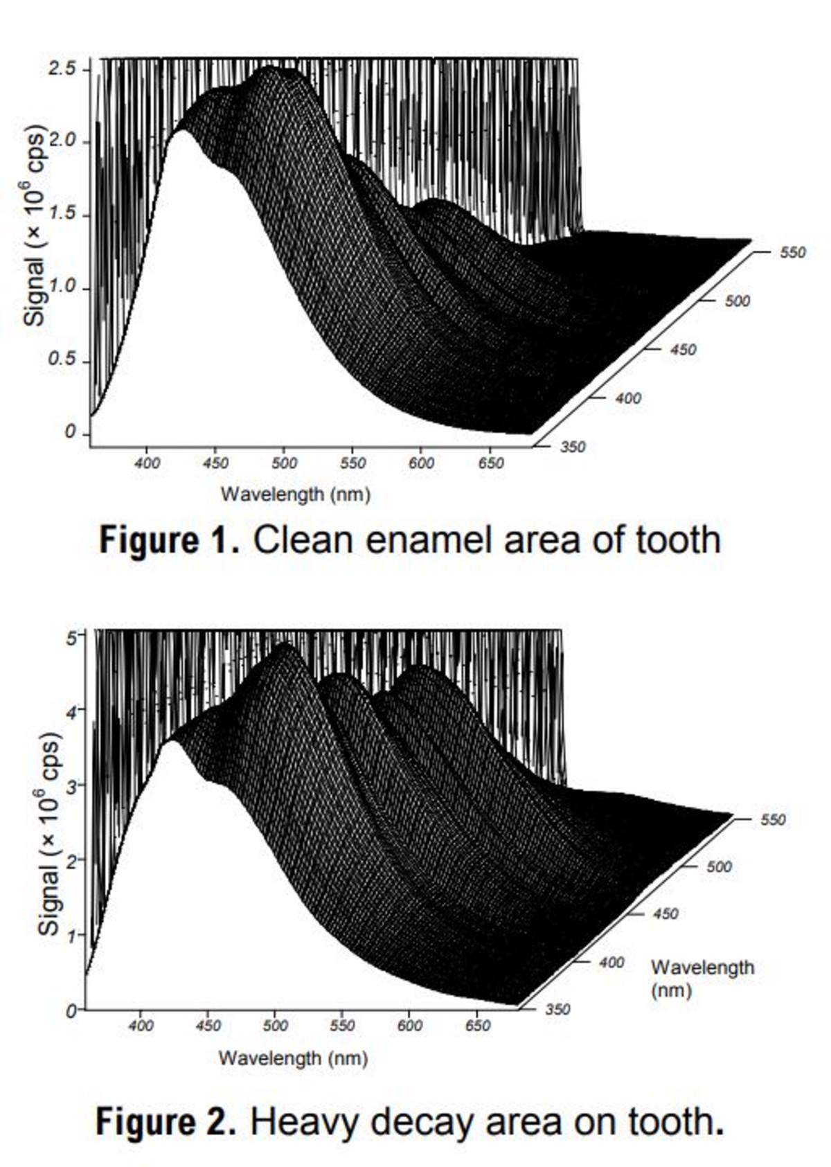 Characterizing Tooth Decay with Fluorescence Introduction