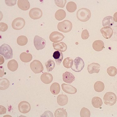 Basophilic_stippling