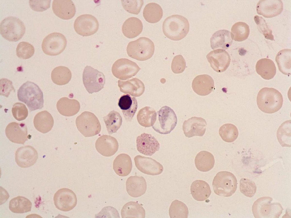 Basophilic_stippling