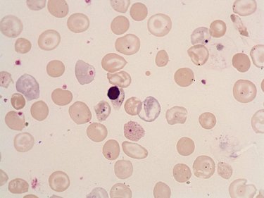 Basophilic_stippling