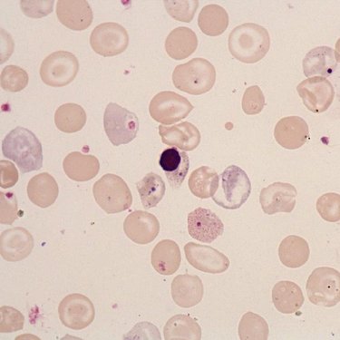 Basophilic_stippling