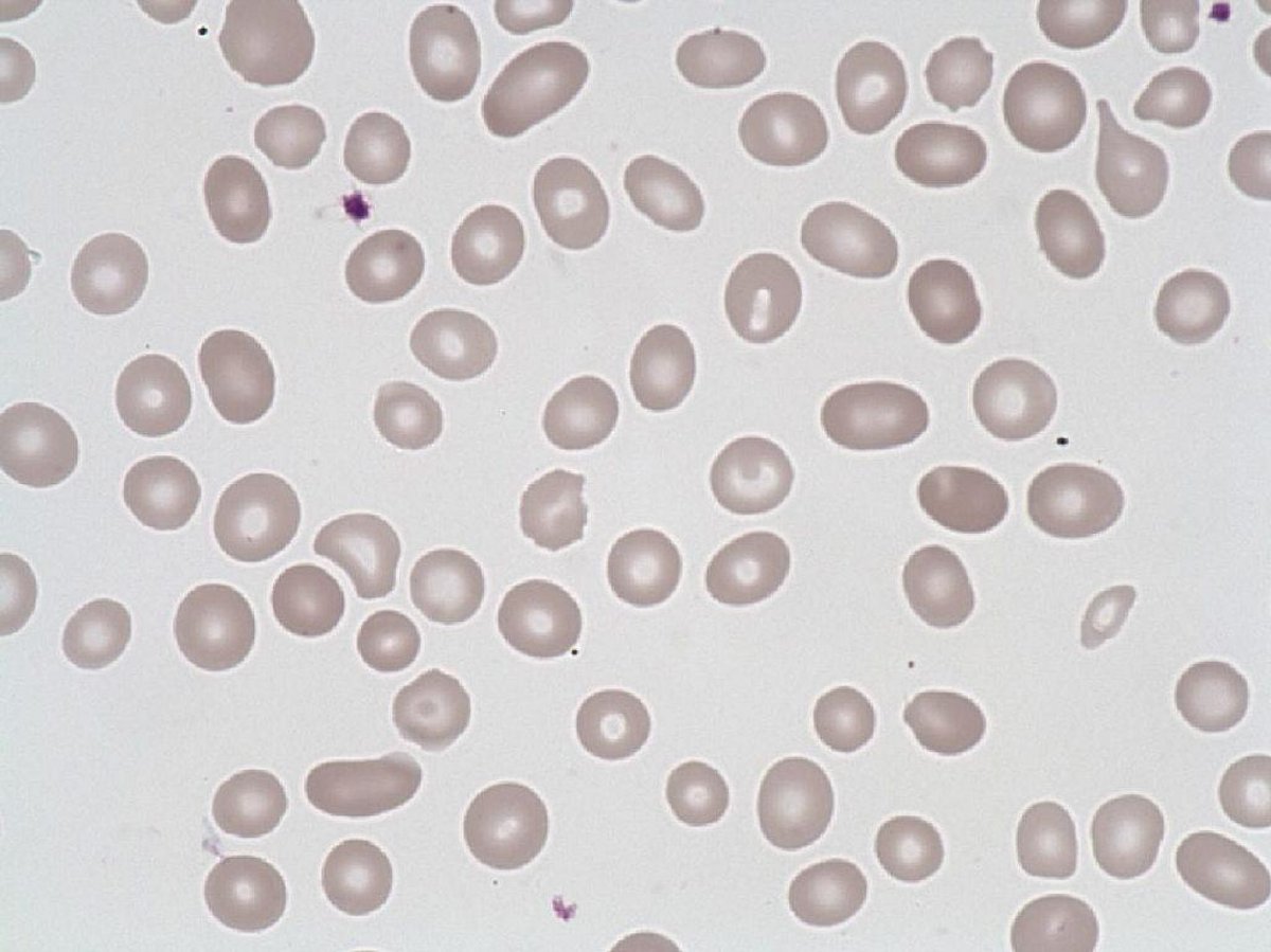 Elliptocyte