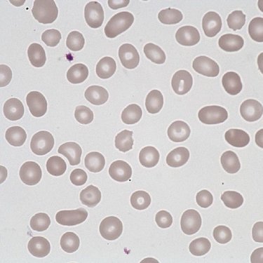 Elliptocyte