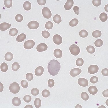 Anisocytosis