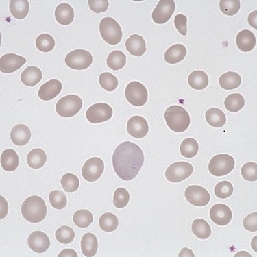 Anisocytosis