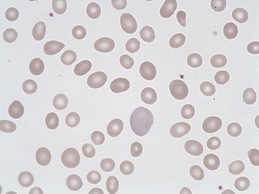 Anisocytosis
