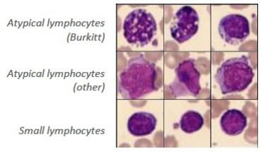 Figure 2: Different atypical lymphocytes identified on MGG-stained blood smear in a case of Burkitt lymphoma