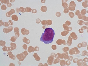 Undifferentiated_blast