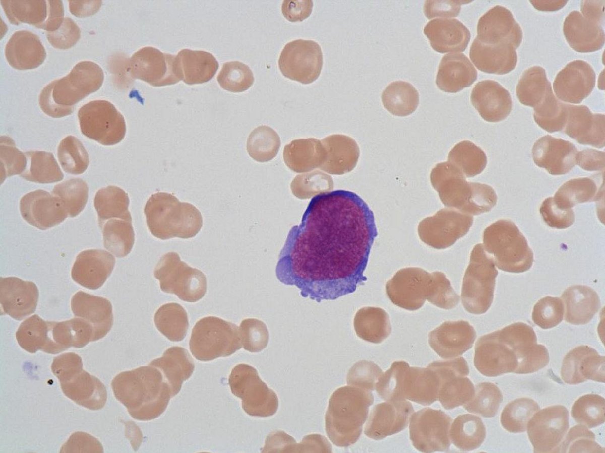 Undifferentiated_blast Undifferentiated_blast