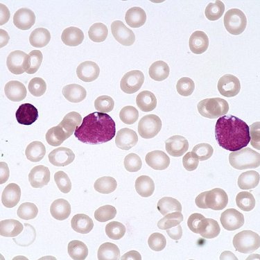 Lymphoblast